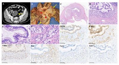 Case report: A rare case of coexistence of low-grade appendiceal mucinous neoplasia and goblet cell adenocarcinoma in the appendix